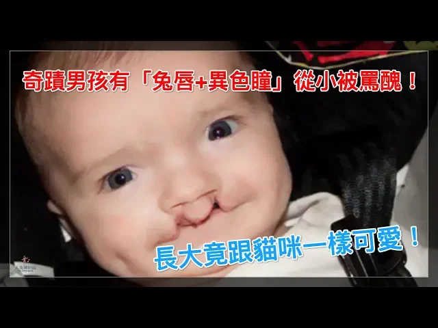 奇蹟男孩有「兔唇+異色瞳」從小被罵醜!長大竟跟貓咪一樣可愛!